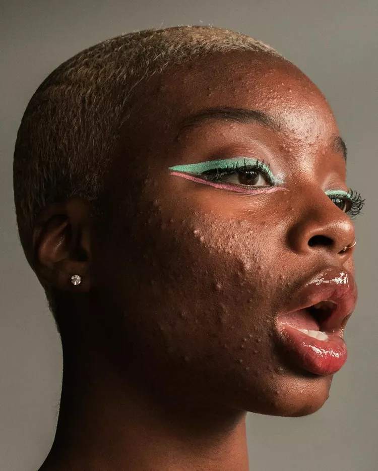 10 Inspiring Images That Prove Acne Is Not Ugly