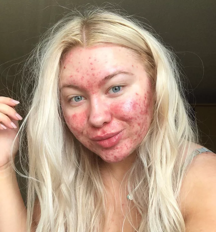 10 Inspiring Images That Prove Acne Is Not Ugly