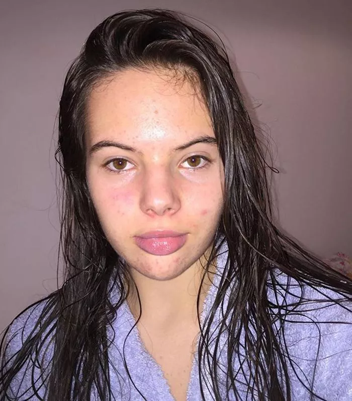 10 Inspiring Images That Prove Acne Is Not Ugly