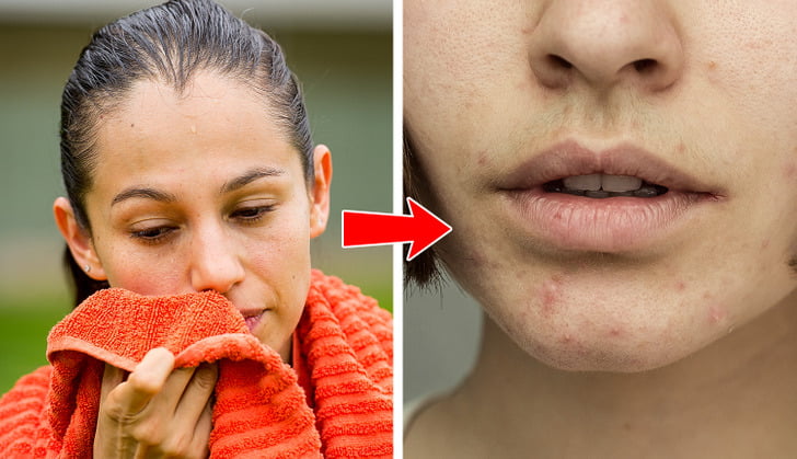 What the Acne on 8 Body Parts Is Trying to Tell You About Your Lifestyle Habits