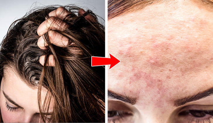 What the Acne on 8 Body Parts Is Trying to Tell You About Your Lifestyle Habits