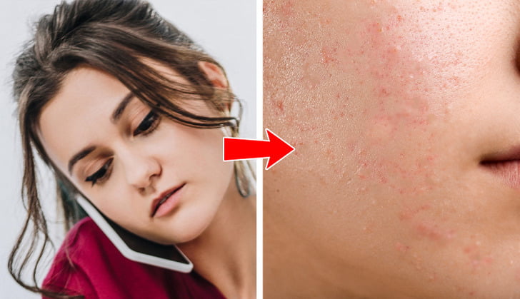 What the Acne on 8 Body Parts Is Trying to Tell You About Your Lifestyle Habits