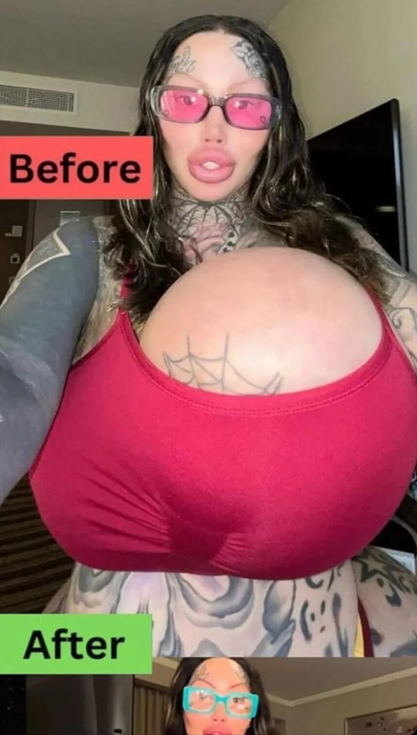 Uni-Boob Model Flaunts New Chest After Implant Explosion