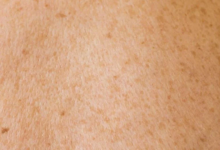 Serious Diseases Diagnosed Through Skin Signals