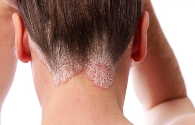 Home Remedies To Get Rid Of Scalp Fungus & Prevention Tips