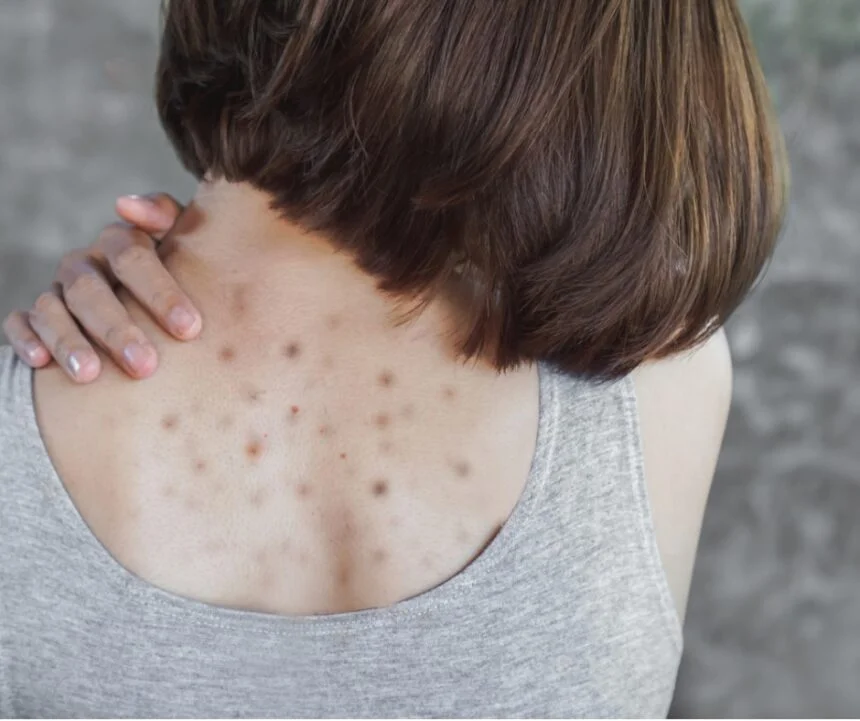 Why Acne Appears on These 8 Body Areas, and What You Should Do 1 Usa People Why Acne Appears on These 8 Body Areas, and What You Should Do