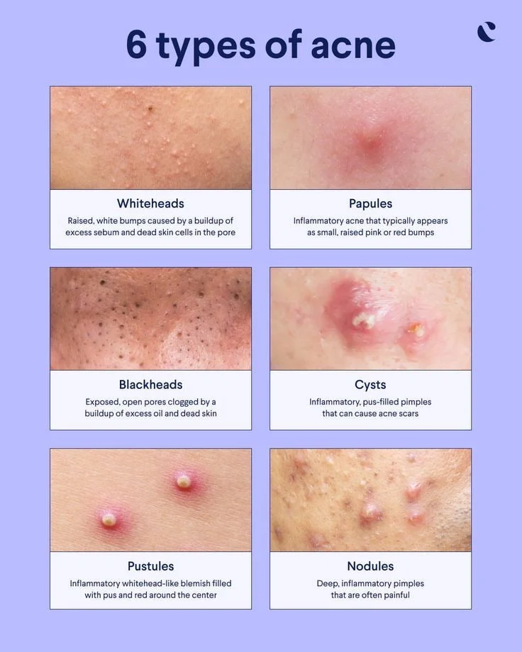 Types of acne: From clogged pores to cysts 1 Usa People Types of acne: From clogged pores to cysts
