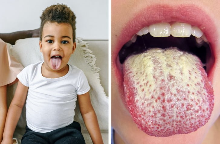 What White Tongue Is, and What to Do About It