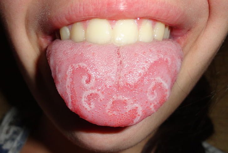 What White Tongue Is, and What to Do About It