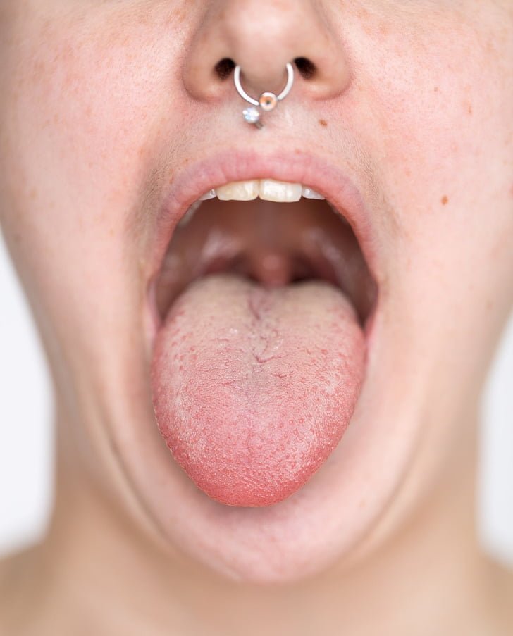 What White Tongue Is, and What to Do About It