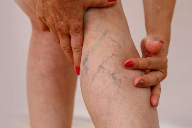 7 Exercises to Reduce Spider and Varicose Veins