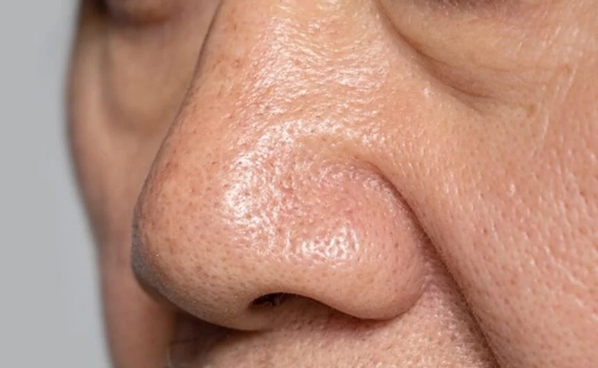10 Tips From Dermatologists That Can Help You to Tighten Large Pores 1 Usa People 10 Tips From Dermatologists That Can Help You to Tighten Large Pores