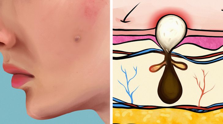 6 Types of Acne and What Might Cause Them