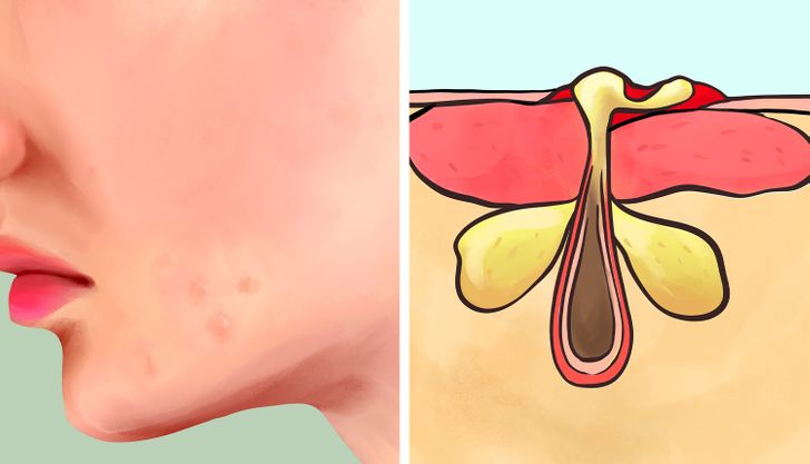 6 Types of Acne and What Might Cause Them