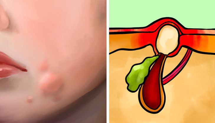 6 Types of Acne and What Might Cause Them