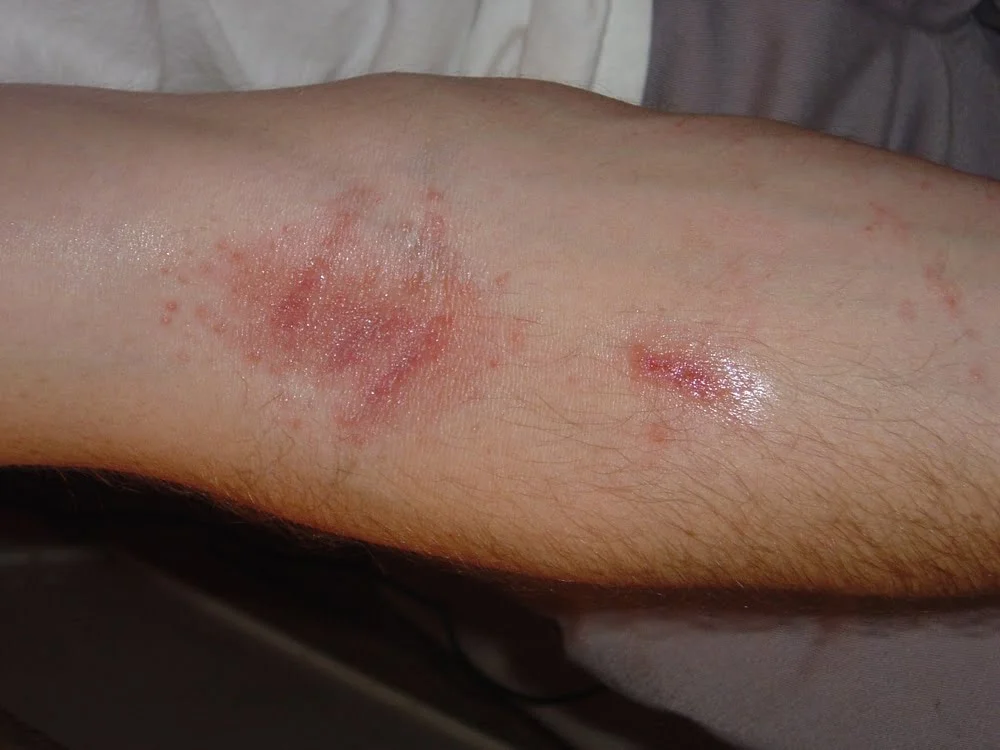 Red Spots on Skin: 13 Common Causes