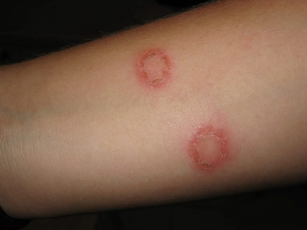 Red Spots on Skin: 13 Common Causes