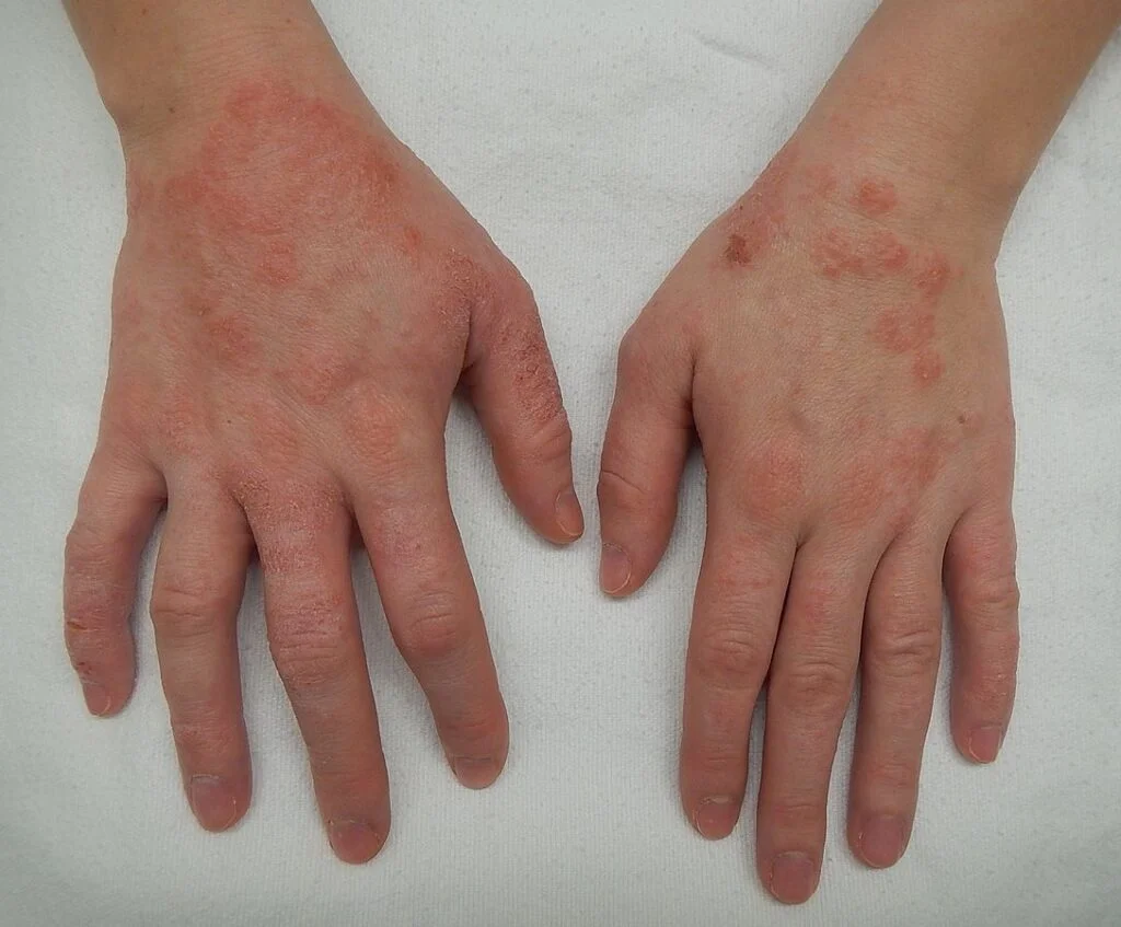 Red Spots on Skin: 13 Common Causes 6 Usa People Red Spots on Skin: 13 Common Causes