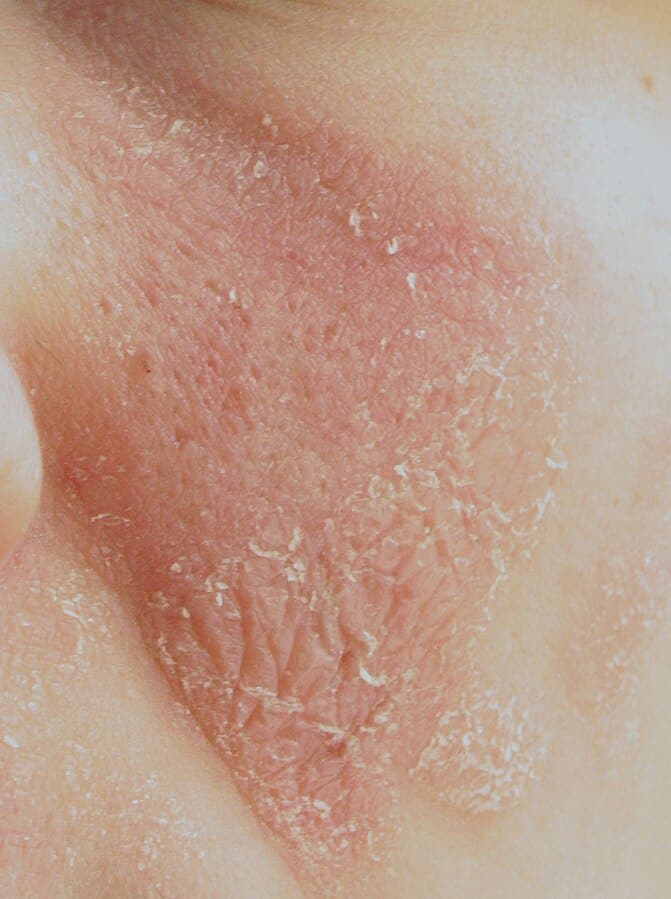 Red Spots on Skin: 13 Common Causes