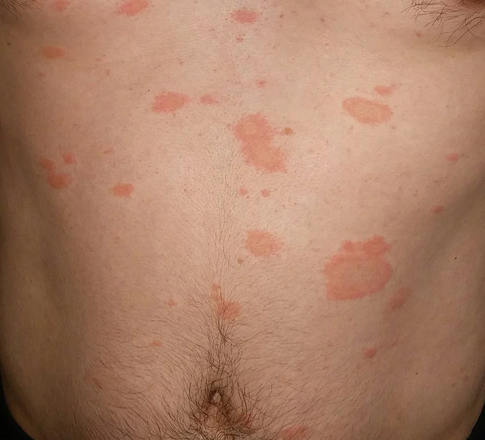 Red Spots on Skin: 13 Common Causes