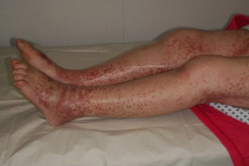 Red Spots on Skin: 13 Common Causes