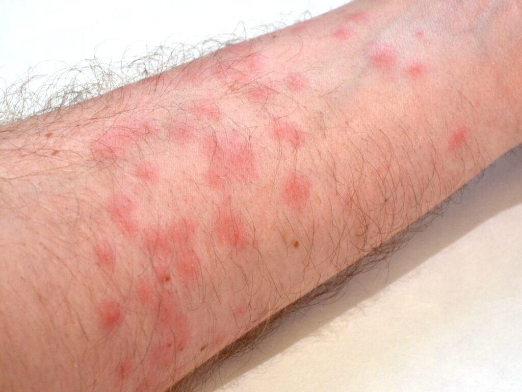 Red Spots on Skin: 13 Common Causes