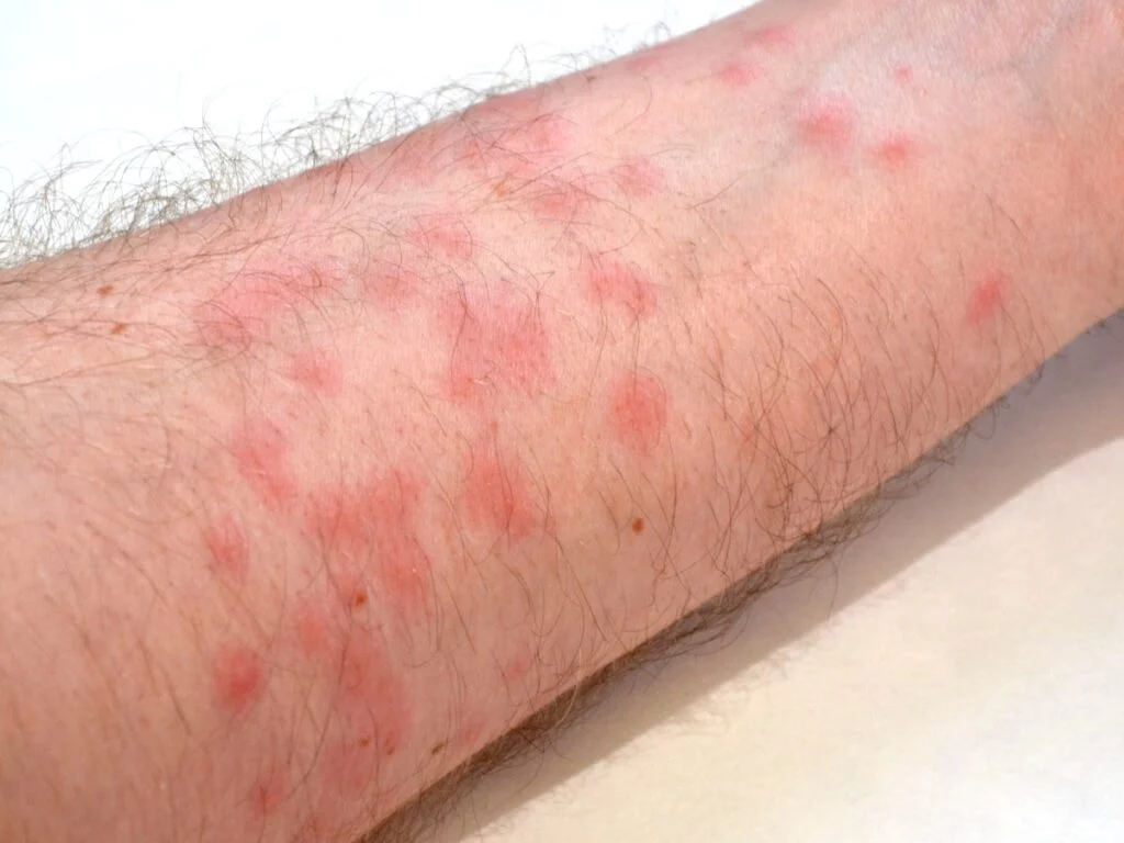 Red Spots on Skin: 13 Common Causes