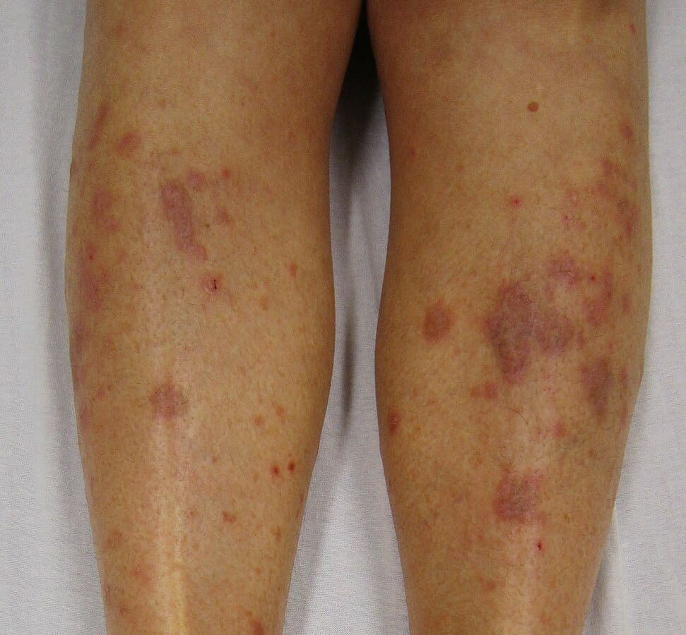 Red Spots on Skin: 13 Common Causes