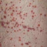Red Spots on Skin: 13 Common Causes