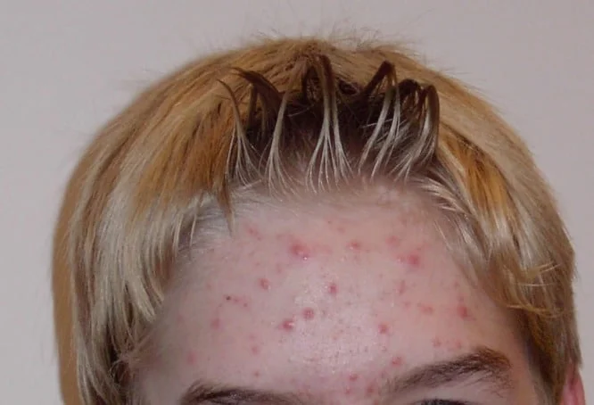 Red Spots on Skin: 13 Common Causes
