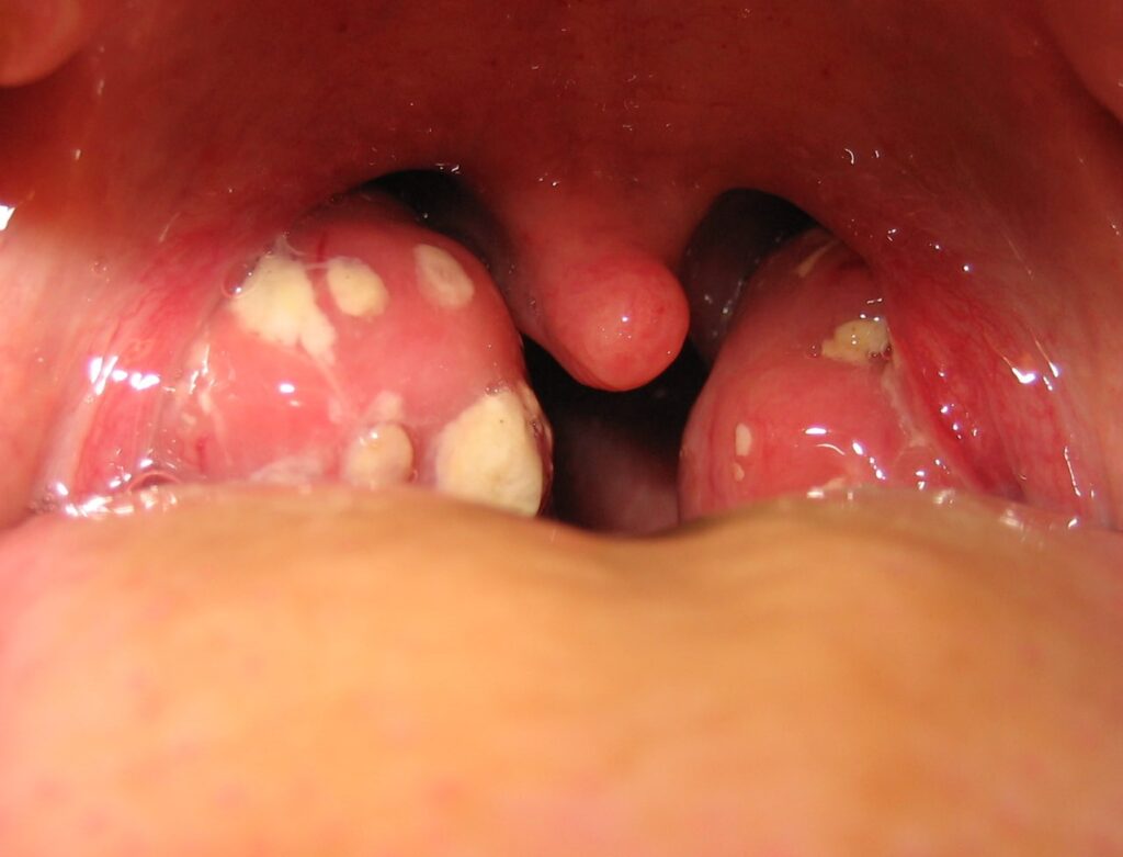 Tonsil Stones: Causes, Symptoms, and Natural Remedies