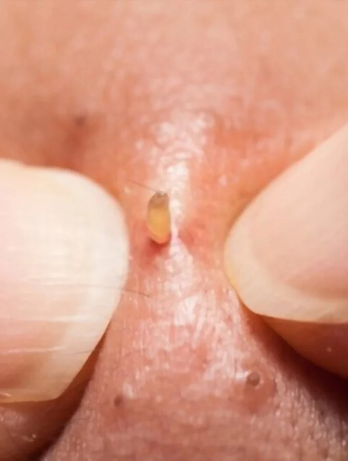 Best 15 Tips For Squeezing Blackheads On Nose 1 Usa People Best 15 Tips For Squeezing Blackheads On Nose
