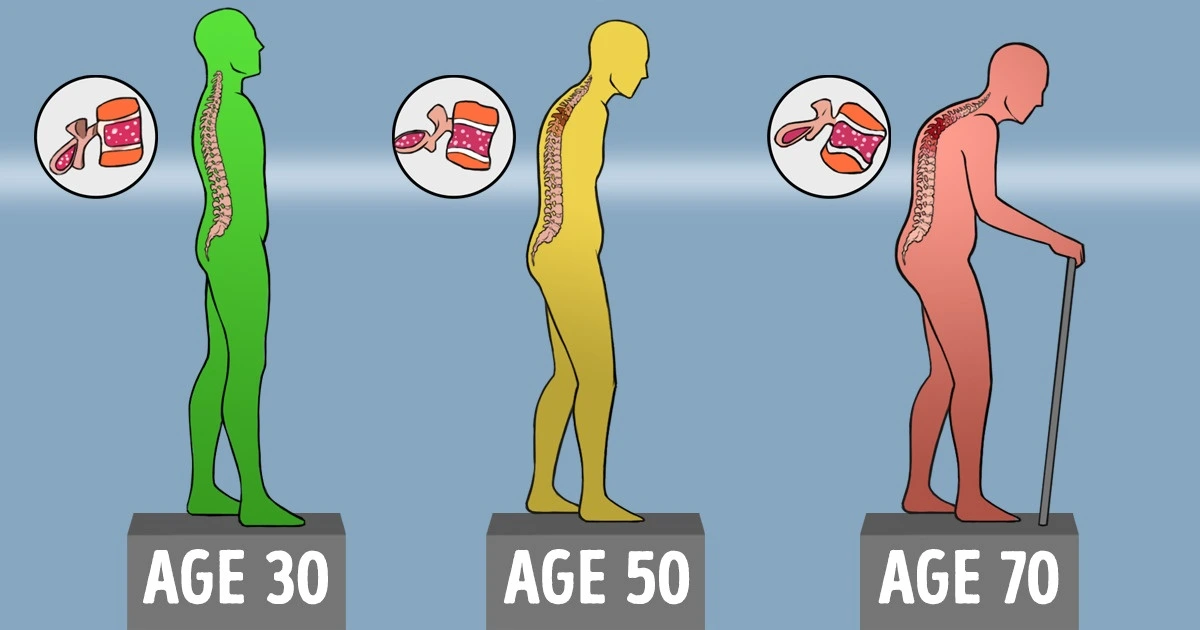 Your Bones Get Weaker Year After Year, but There Are Ways to Keep Them Healthy