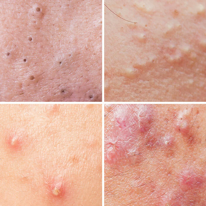 6 Types of Acne and What Might Cause Them